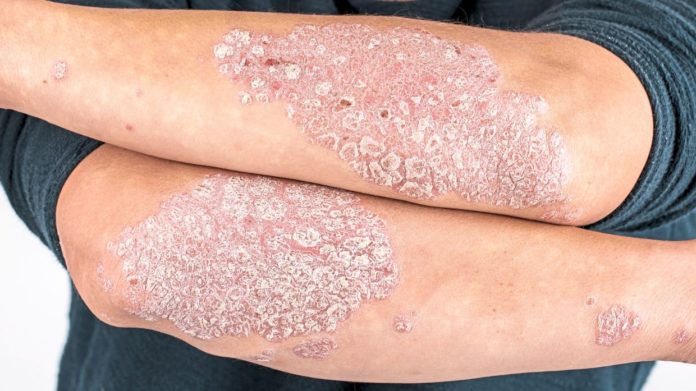 CBD for Psoriasis