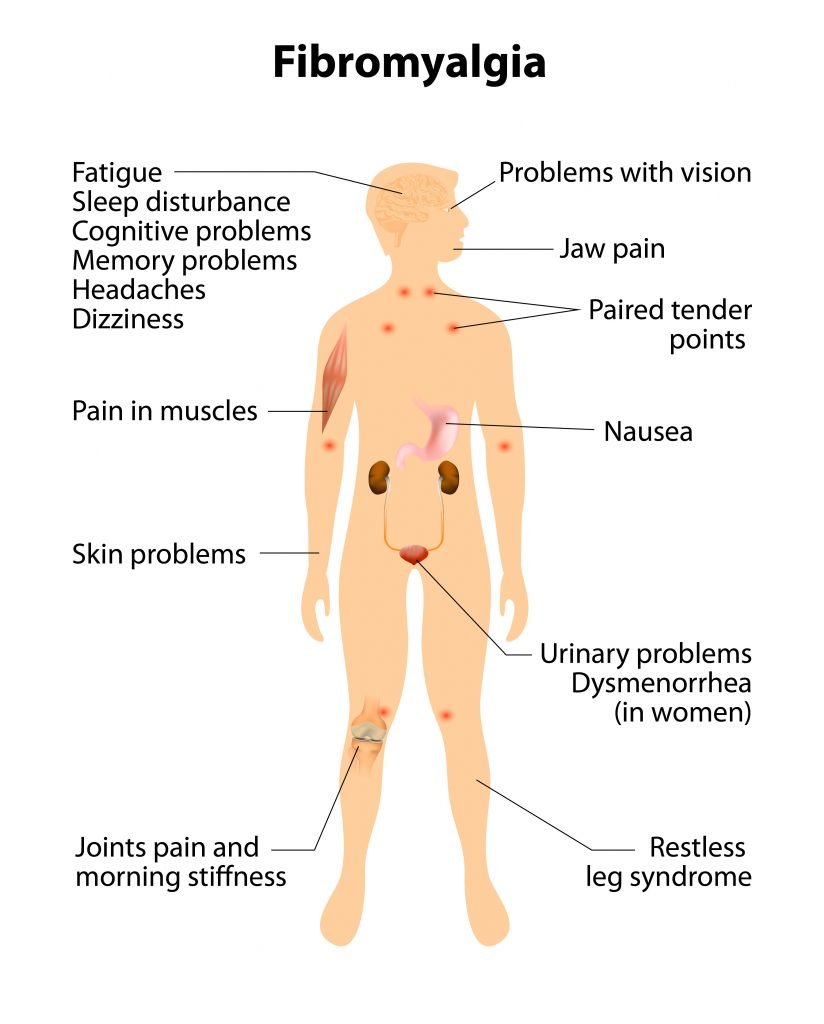 fibromyalgia symptoms cbd