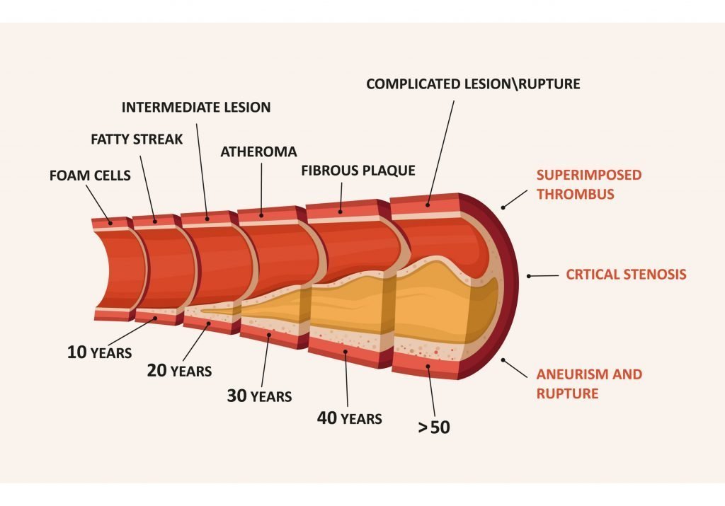 atherosclerosis